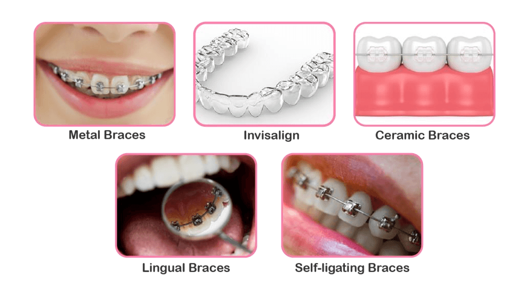 Braces & Aligners