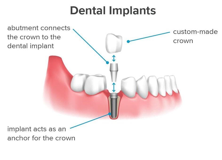 Dental Implants