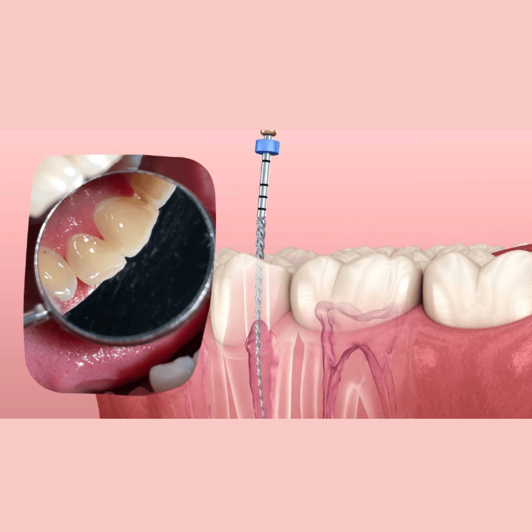 Root Canal