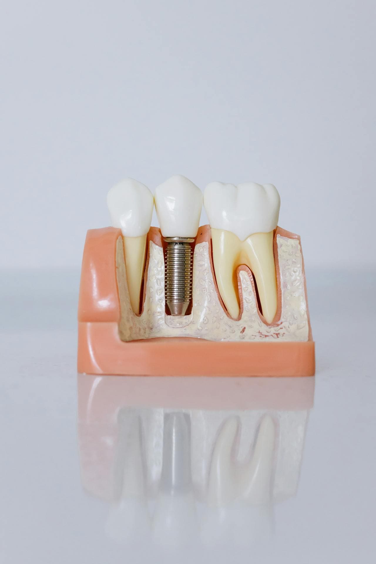 Tooth Implant Procedures