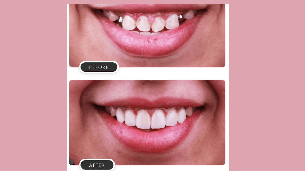 What are Composite Fillings?