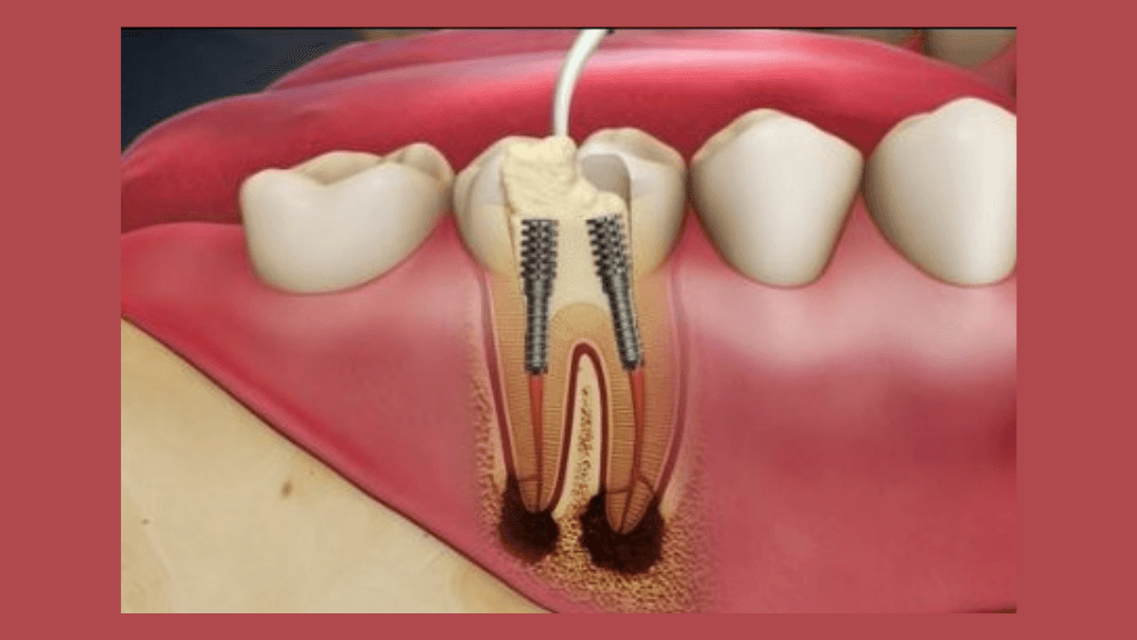 What is Post and Core?