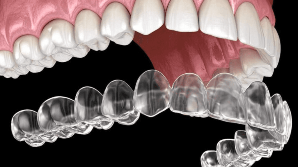 What are Clear Aligners?