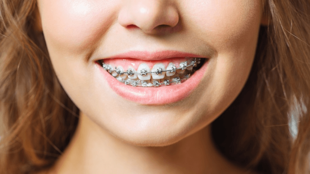 What are Self Ligating Metal Braces?