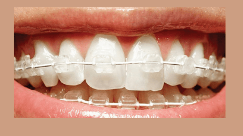 What are Straight Wire Ceramic Braces?