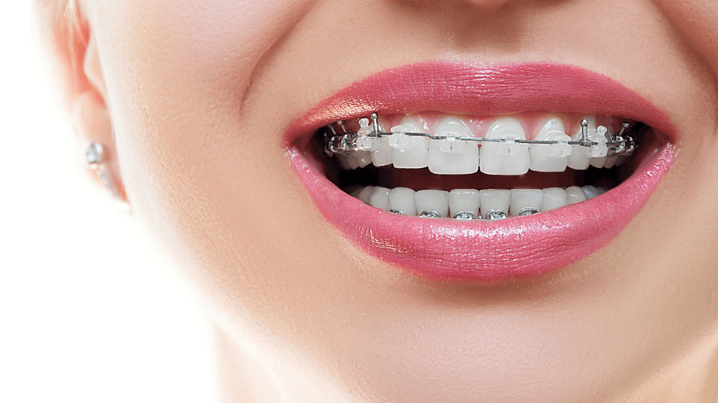 What are Straight Wire Metal Braces?