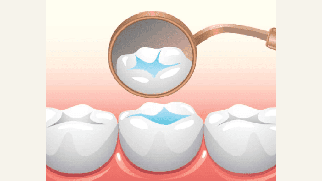 What is Pit and Fissure Sealant?